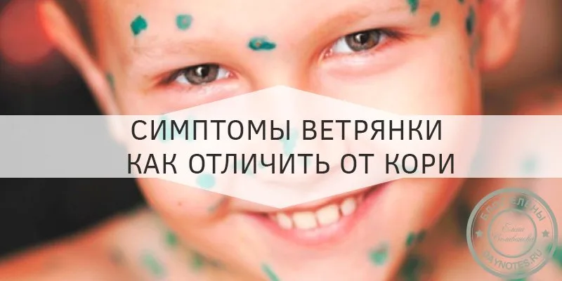 ветрянка у детей симптомы